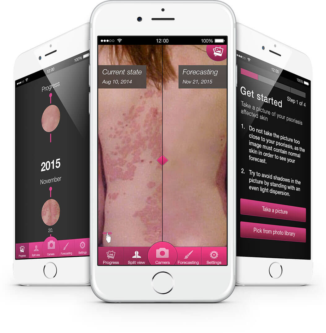 Psoriasis APP